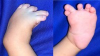6 bulan setelah operasi, bentuk kaki bayi menunjukkan perkembangan yang baik meski ia belum memasuki usia berjalan. Karena keterbatasan fasilitas di Aceh, pasien akhirnya dirujuk ke Jakarta untuk perawatan lanjutan. (Foto: Journal of International Surgery and Clinical Medicine (JISCM))