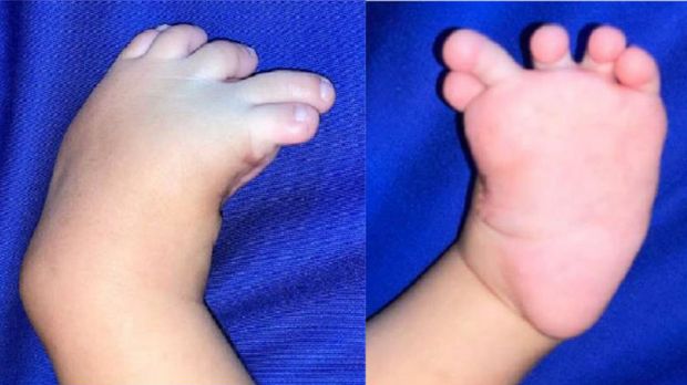 Penemuan bocah jari kaki kiri 10. Penemuan bocah jari kaki kiri 10.