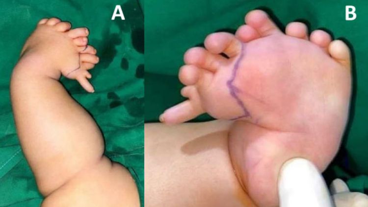 Foto: Bayi Aceh Idap Kondisi Langka, Punya 10 Jari di Kaki Kiri