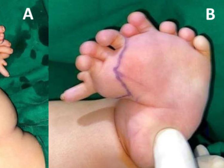 Foto: Bayi Aceh Idap Kondisi Langka, Punya 10 Jari di Kaki Kiri