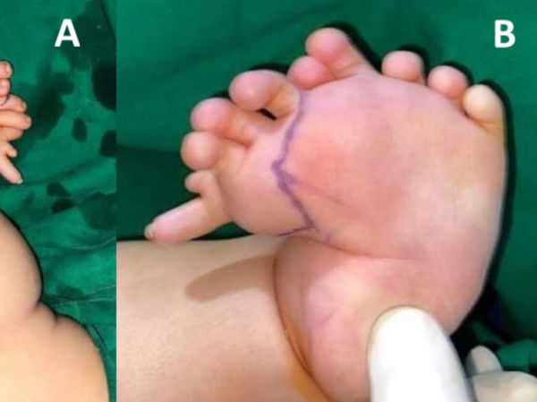 Foto: Bayi Aceh Idap Kondisi Langka, Punya 10 Jari di Kaki Kiri