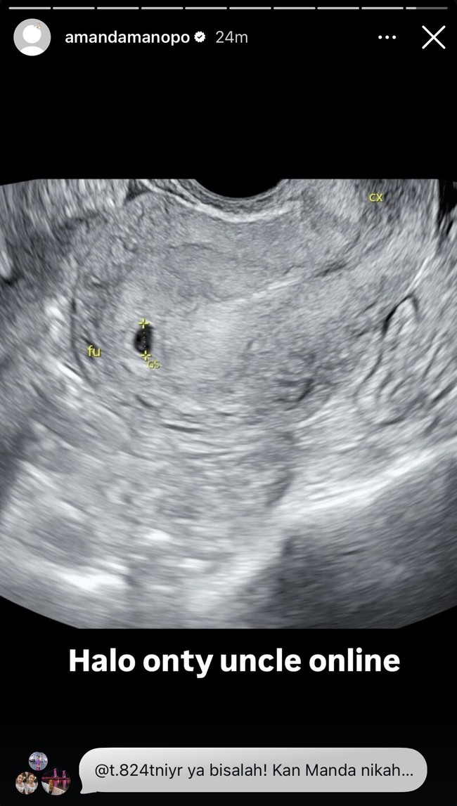Di Instagram Story miliknya, Amanda juga memamerkan hasil USG kehamilannya. Meski masih hamil muda, namun tampaknya Amanda dan Kenny sudah tak sabar menanti kehadiran anak pertama mereka. Foto: Instagram/@amandamanopo