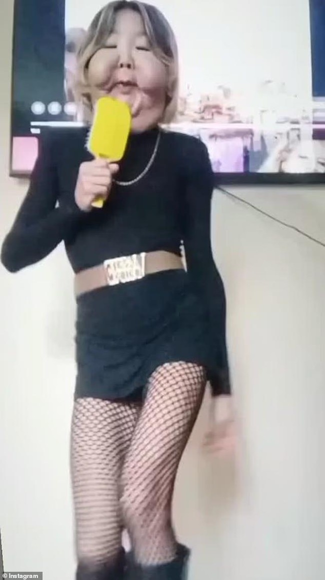 Awalnya, Juju mengira dirinya disuntik filler berbahan dasar silikon. Namun kenyataannya, ia menerima 21 suntikan berisi minyak mineral dan obat pencahar ke bagian pipi, tanpa persetujuan. Bahan asing tersebut membuat wajahnya membengkak parah, terutama di area pipi dan kelopak mata. Foto: dok. Instagram