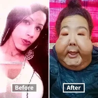 Padahal sebelum prosedur itu, Juju memiliki wajah yang normal dan cantik. Dalam salah satu video before-after yang dibagikan, terlihat bahwa bagian dagu menjadi salah satu titik yang paling terdampak dan membutuhkan perbaikan. Foto: dok. Instagram