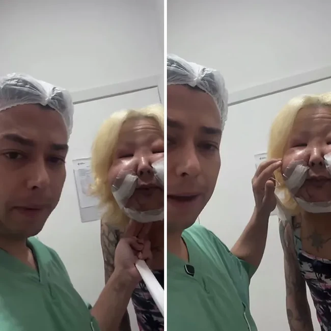 Operasi tersebut berlangsung lebih dari empat jam, dan menurut laporan, tindakan ini baru merupakan tahap pertama dari rangkaian operasi rekonstruksi yang harus dijalani Juju. Foto: dok. Instagram