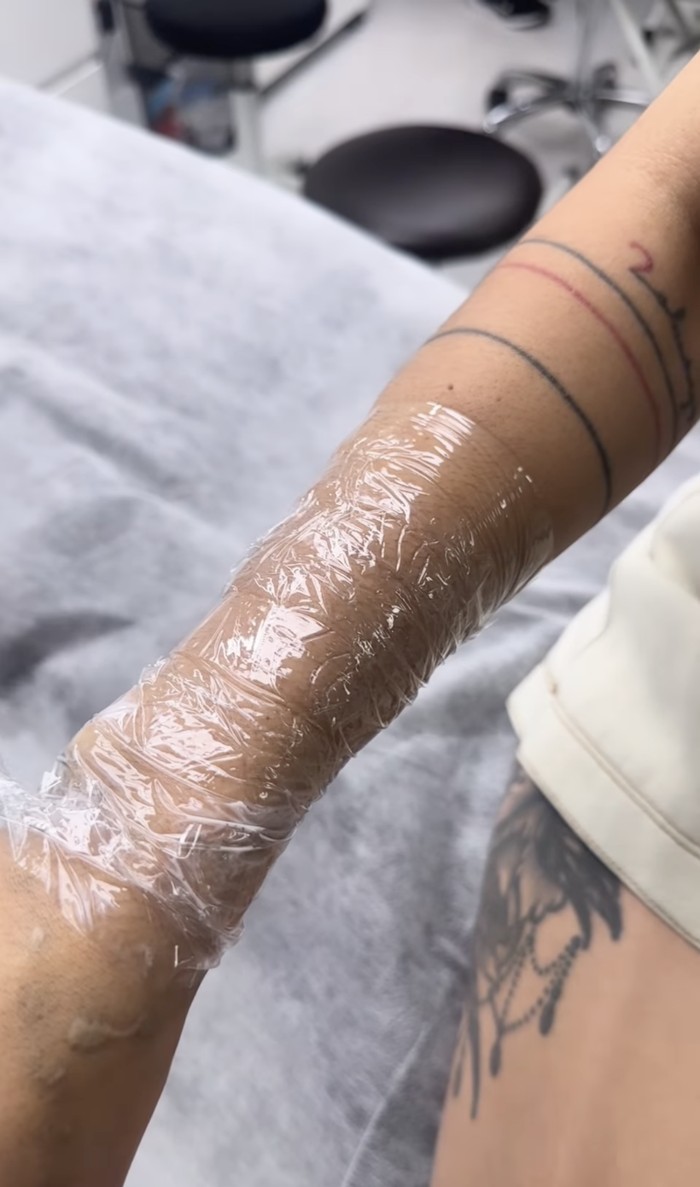 Momen ketika Sheila Marcia menahan sakit karena hapus tato.