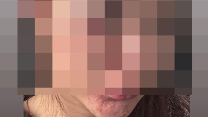 Viral Perempuan di Malang Jadi Korban Kekerasan Pasangan hingga Lebam