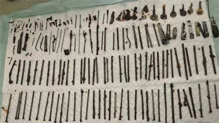 Ngilu! Dokter Temukan 120 Benda Asing di Perut Pasien, Ada Pisau-Gunting
