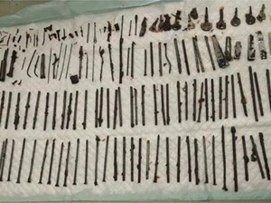 Ngilu! Dokter Temukan 120 Benda Asing di Perut Pasien, Ada Pisau-Gunting