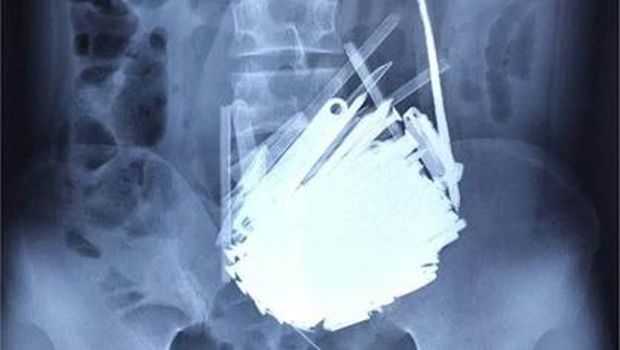 Temuan benda asing dalam perut pasien. Temuan benda asing dalam perut pasien.