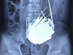 Ratusan Benda Asing Berada dalam Perut Pria 39 Tahun di China