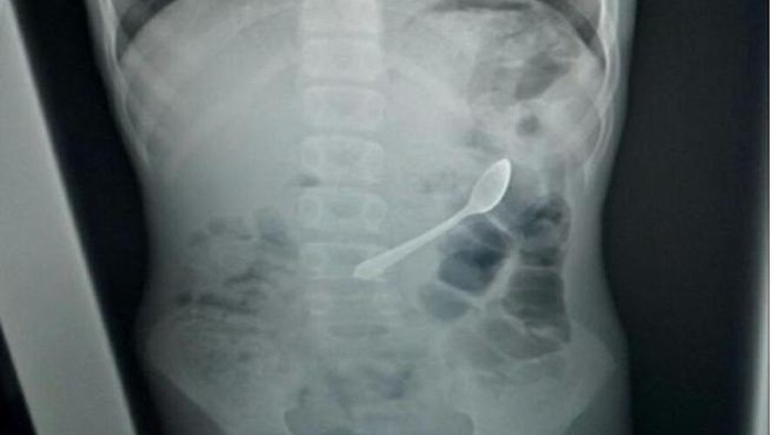 Ngilu! Bocah Ini Tak Sengaja Telan Sendok, Baru Dikeluarkan 10 Hari Kemudian