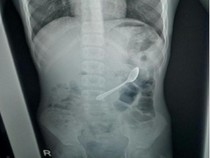 Ngilu! Bocah Ini Tak Sengaja Telan Sendok, Baru Dikeluarkan 10 Hari Kemudian