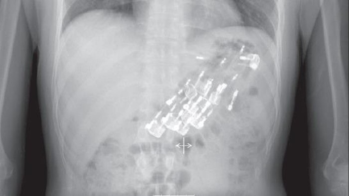 Penampakan 10 korek dalam tubuh pasien pria.