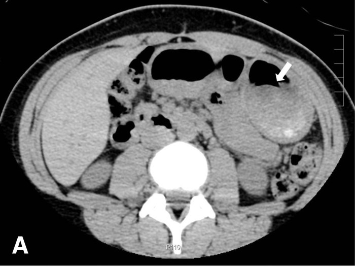 Seorang wanita berusia 21 tahun datang ke UGD rumah sakit. Ia mengaku tidak sengaja menelan sendok kayu saat makan es krim, begini penampakannya.