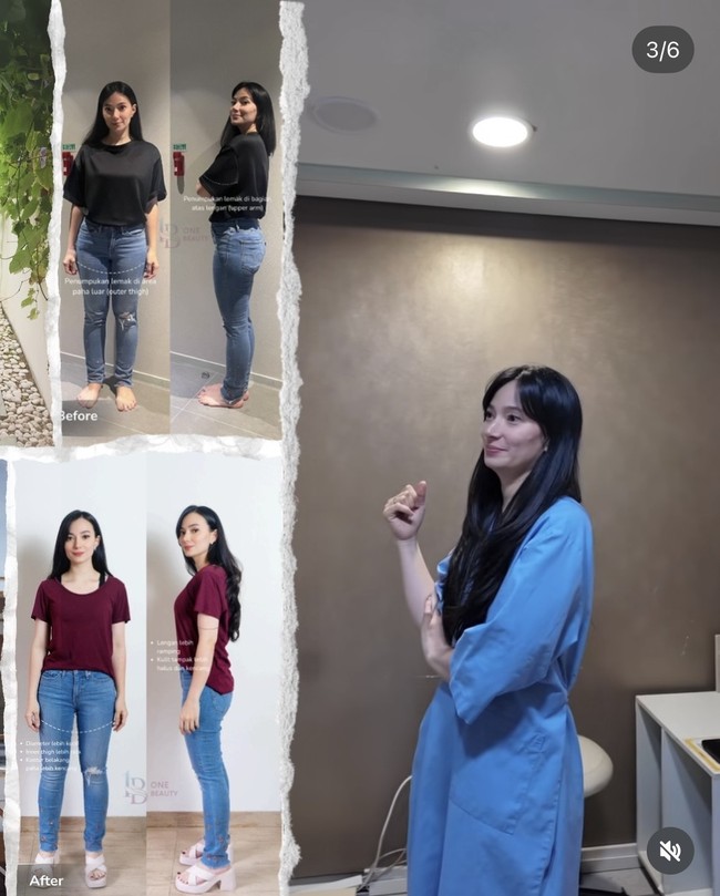 Istri Jonas Rivanno itu juga membagikan foto-foto perbedaan tubuhnya sebelum dan setelah menjalani sedot lemak. Terlihat kini dirinya semakin langsing dan cantik. Foto: Instagram/@asmirandah89