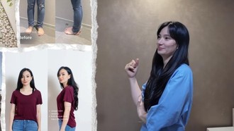 Transformasi Asmirandah Before-After Sedot Lemak, Makin Cantik dan Langsing