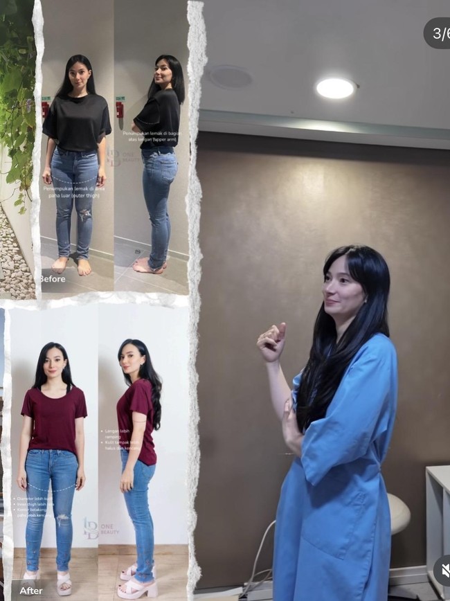 Transformasi Asmirandah Before-After Sedot Lemak, Makin Cantik dan Langsing