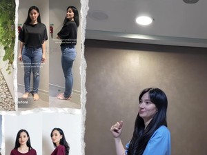 Transformasi Asmirandah Before-After Sedot Lemak, Makin Cantik dan Langsing