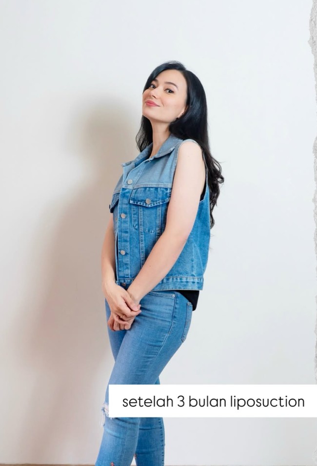 Penampilan terbaru Asmirandah setelah 3 bulan pasca operasi. Ia mengaku lingkar lengan, pinggul, dan pinggangnya jadi jauh berkurang. Lingkar lengan tangan dari 30 cm sekarang 25 cm. Lingkar pinggul dari 106 cm sekarang 93 cm. Lingkar pinggang dari 85 cm sekarang 68 cm, tulisnya. Foto: Instagram/@asmirandah89