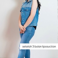 Penampilan terbaru Asmirandah setelah 3 bulan pasca operasi. Ia mengaku lingkar lengan, pinggul, dan pinggangnya jadi jauh berkurang. Lingkar lengan tangan dari 30 cm sekarang 25 cm. Lingkar pinggul dari 106 cm sekarang 93 cm. Lingkar pinggang dari 85 cm sekarang 68 cm, tulisnya. Foto: Instagram/@asmirandah89