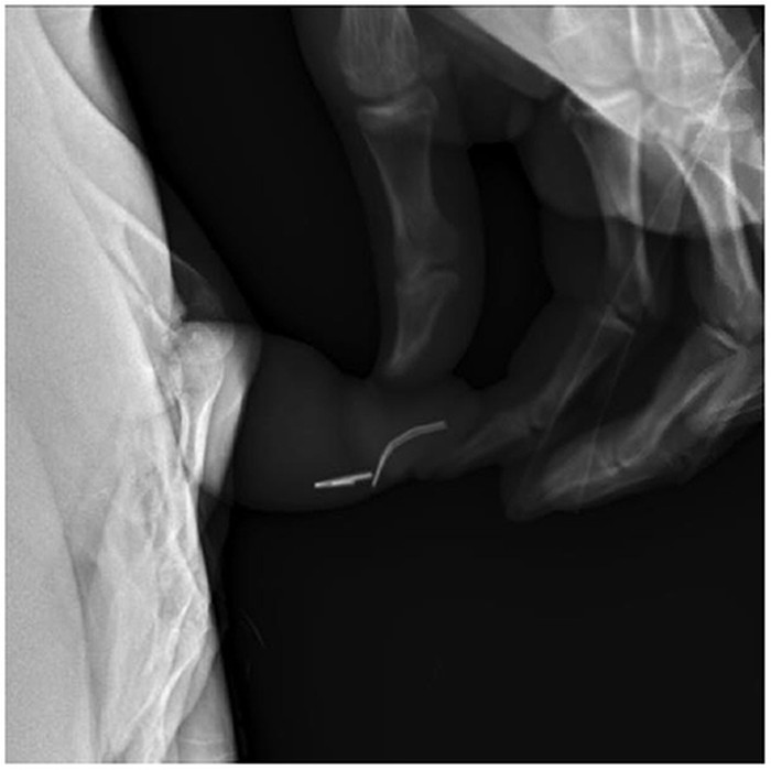 Seorang remaja berusia 17 tahun memasukkan benda asing ke dalam uretranya sendiri. Tak hanya sekali, ia memasukkan total 20 kali hingga dilarikan ke UGD.