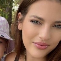 Impian Mirip Kylie Jenner Berujung Koma, Kisah Pilu Wanita yang Oplasnya Gagal