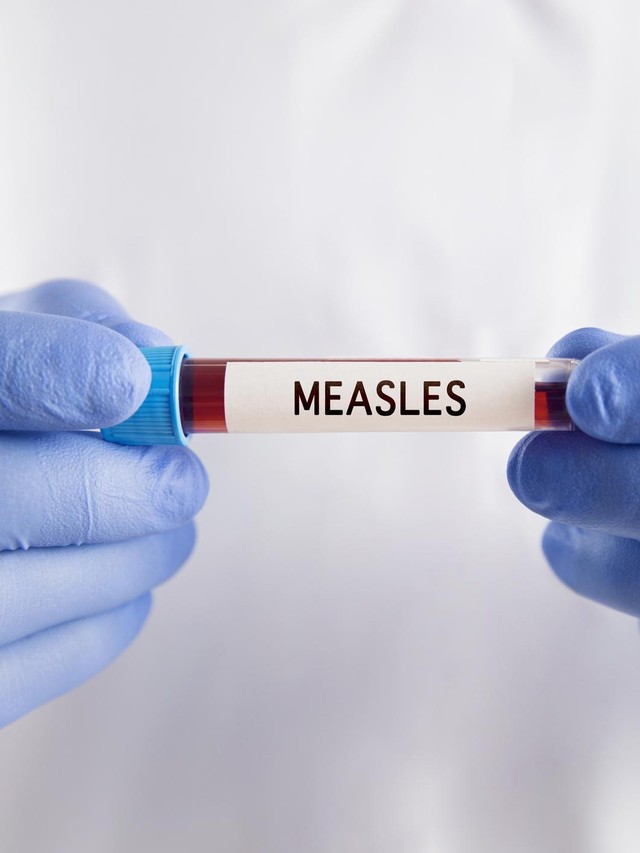 Lagi Campak Malah Keluyuran