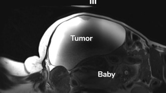 Langka! Ibu Ini Lahirkan Bayi dari Kehamilan di Luar Rahim dengan Kista Hampir 10 Kg