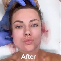 Berawal dari Filter Medsos, Wanita Ini Oplas Wajah dan Berakhir Menyesal