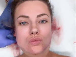 Berawal dari Filter Medsos, Wanita Ini Oplas Wajah dan Berakhir Menyesal