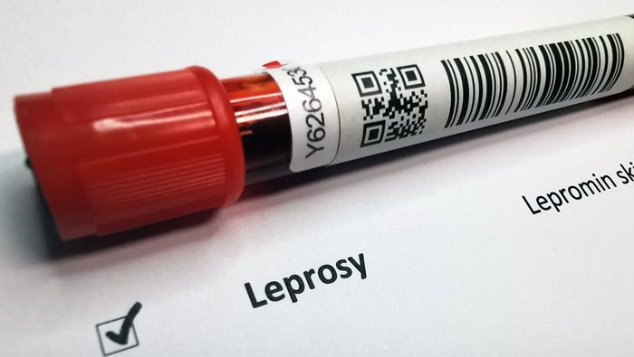 Kronologi WNI di Rumania Terkena Kusta, Jadi Kasus Pertama usai 44 Tahun