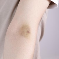 Sering Memar Tanpa Sebab? Ini 10 Penyebabnya Menurut Ahli Kesehatan