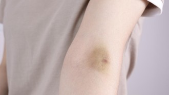 Sering Memar Tanpa Sebab? Ini 10 Penyebabnya Menurut Ahli Kesehatan