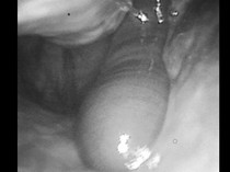 Pria Mimisan Berhari-hari, Ternyata Ada Lintah Hidup di Hidungnya