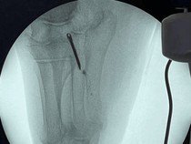 Ngilu! Besi 6,5 Cm Nancap di Kaki Nenek Selama Puluhan Tahun