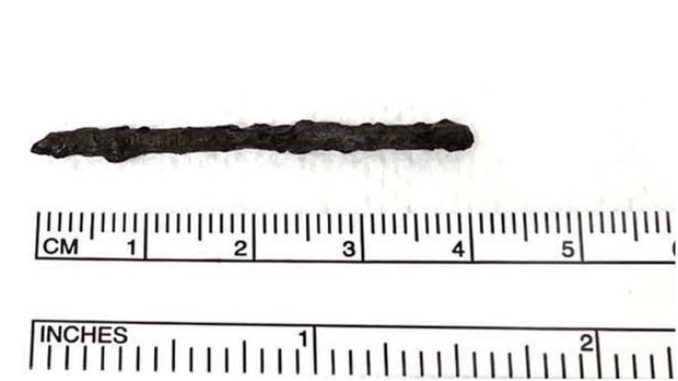 Penampakan benda asing besi di kaki pasien.