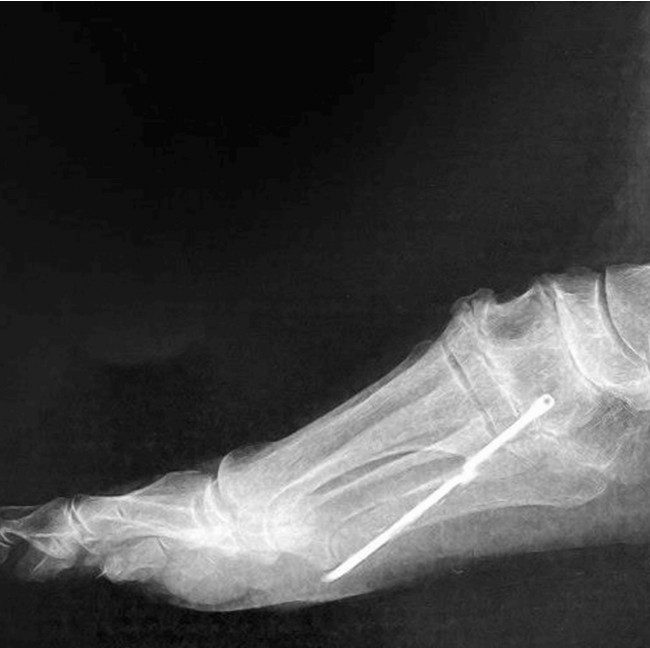 Penampakan Batang Besi Nancap di Kaki Pasien, Baru Ketahuan Setelah 40 Tahun