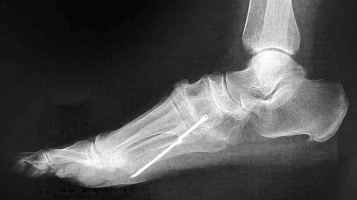 Penampakan benda asing besi di kaki pasien.