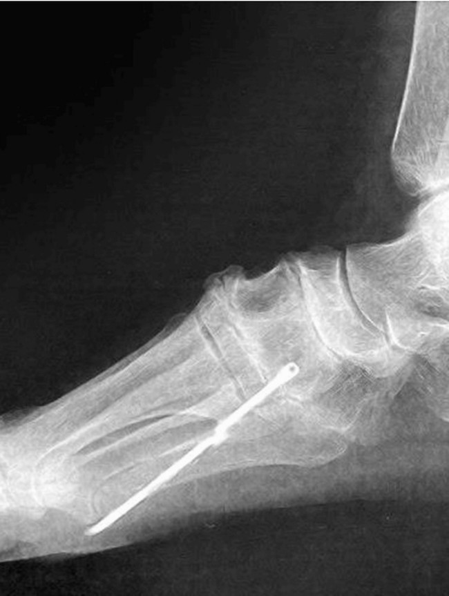 Penampakan Batang Besi Nancap di Kaki Pasien, Baru Ketahuan Setelah 40 Tahun