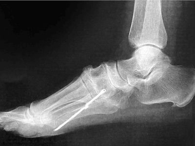 Penampakan Batang Besi Nancap di Kaki Pasien, Baru Ketahuan Setelah 40 Tahun