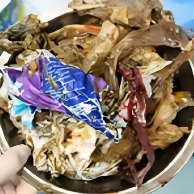 Duh! Dokter Temukan 1 Kg Sampah Plastik di Perut Pasien, Ini Penampakannya