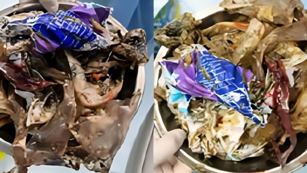 Duh! Dokter Temukan 1 Kg Sampah Plastik di Perut Pasien, Ini Penampakannya