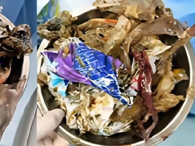 Duh! Dokter Temukan 1 Kg Sampah Plastik di Perut Pasien, Ini Penampakannya