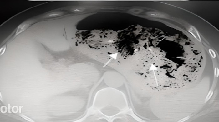 Penampakan plastik 1 kg dalam tubuh pasien.