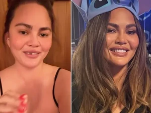Waduh! Gigi Chrissy Teigen Copot Usai Gigit Permen Tongkat
