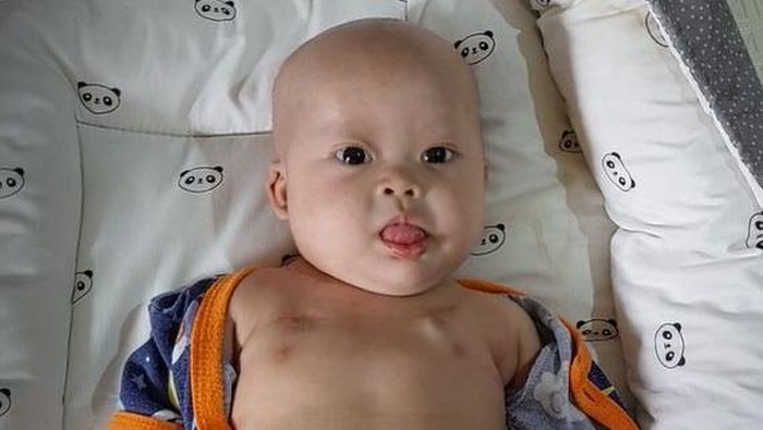 Kisah Chiara Bayi Penderita Tumor Teratoma Immature, Berjuang Ingin Sembuh