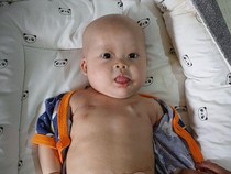 Kisah Chiara Bayi Penderita Tumor Teratoma Immature, Berjuang Ingin Sembuh