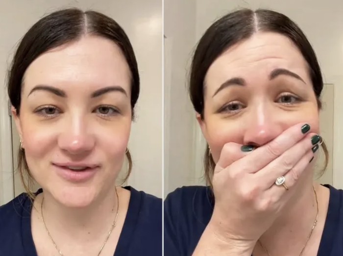 Wanita ini kaget dengan efek botoxnya