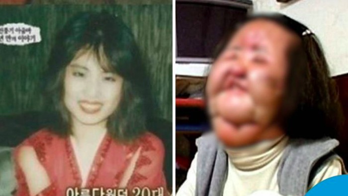 Kisah Tragis Aktris Korea yang Wajahnya Rusak Usai Suntik Minyak Goreng